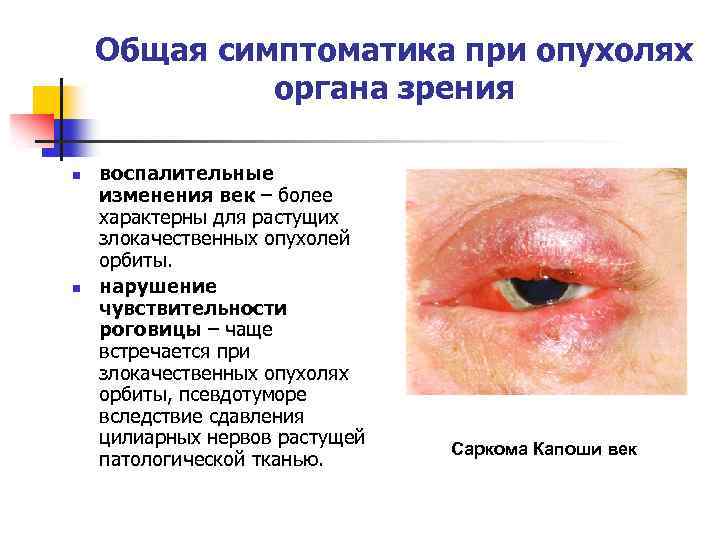 Общая симптоматика при опухолях органа зрения n n воспалительные изменения век – более характерны