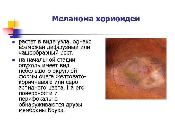 Меланома хориоидеи n n растет в виде узла, однако возможен диффузный или чашеобразный рост.