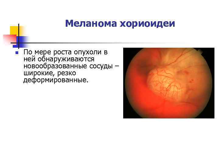 Меланома хориоидеи n По мере роста опухоли в ней обнаруживаются новообразованные сосуды – широкие,
