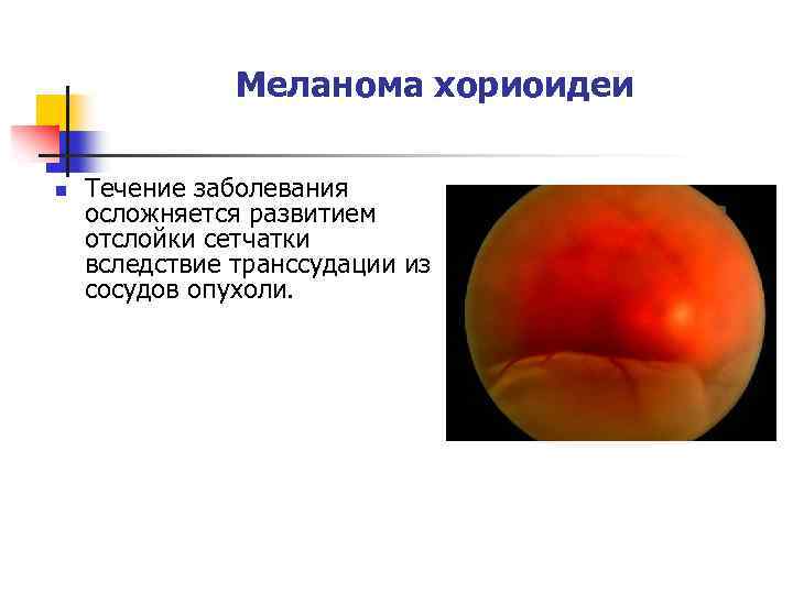 Меланома хориоидеи n Течение заболевания осложняется развитием отслойки сетчатки вследствие транссудации из сосудов опухоли.