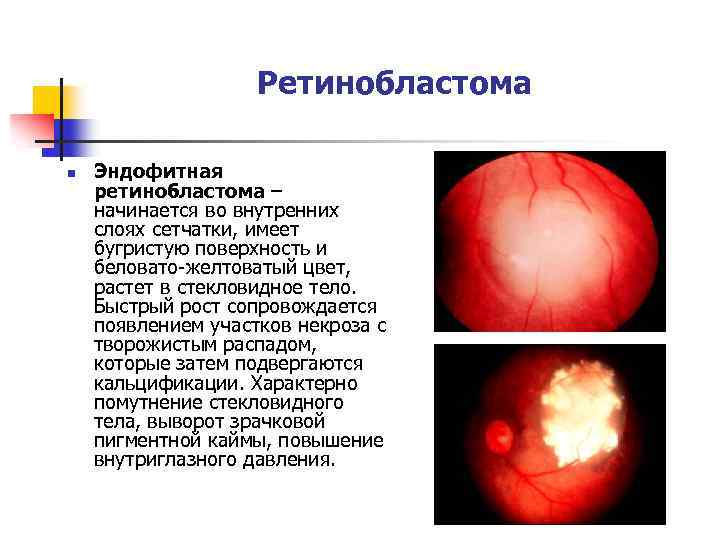 Ретинобластома n Эндофитная ретинобластома – начинается во внутренних слоях сетчатки, имеет бугристую поверхность и