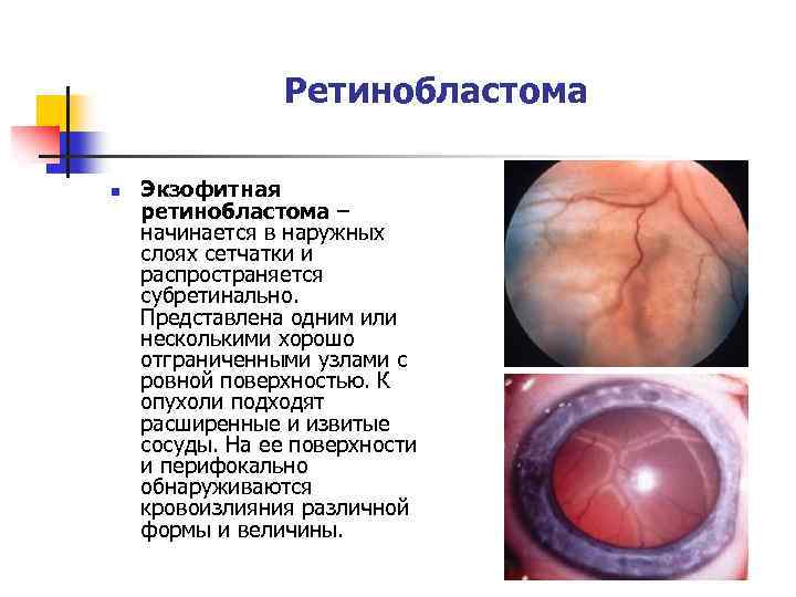 Ретинобластома n Экзофитная ретинобластома – начинается в наружных слоях сетчатки и распространяется субретинально. Представлена