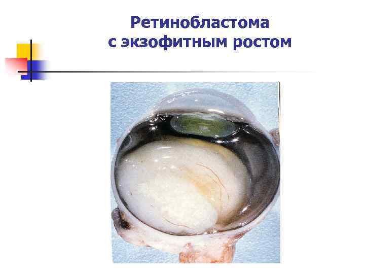 Ретинобластома с экзофитным ростом 