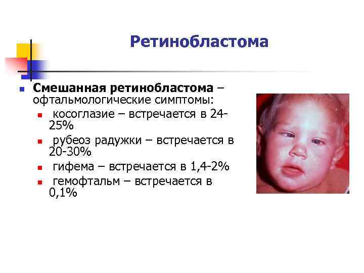 Ретинобластома n Смешанная ретинобластома – офтальмологические симптомы: n косоглазие – встречается в 2425% n
