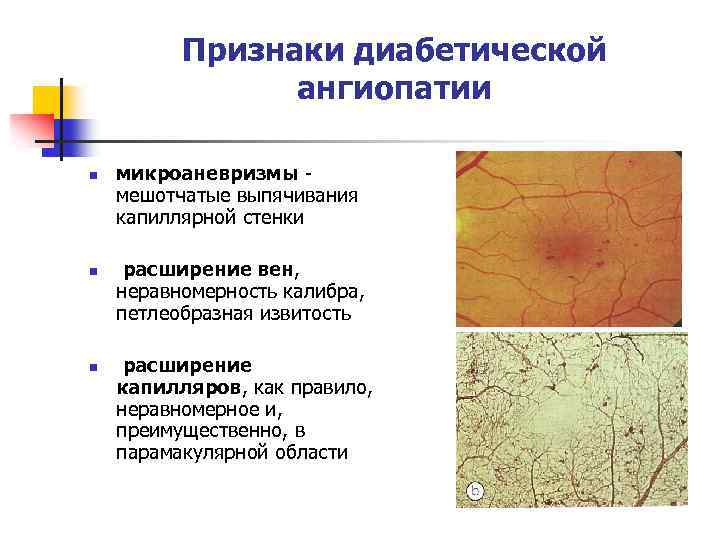 Признаки диабетической ангиопатии n n n микроаневризмы мешотчатые выпячивания капиллярной стенки расширение вен, неравномерность