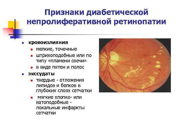 Диабетическая ретинопатия лечение