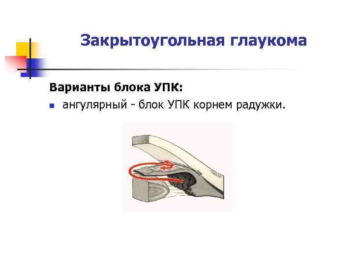 Закрытоугольная глаукома Варианты блока УПК: n ангулярный - блок УПК корнем радужки. 