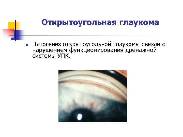 Открытоугольная глаукома n Патогенез открытоугольной глаукомы связан с нарушением функционирования дренажной системы УПК. 