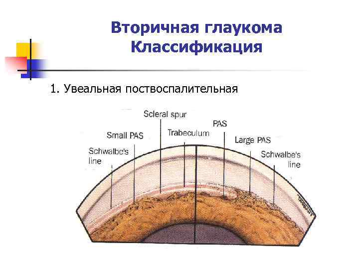 Вторичная глаукома Классификация 1. Увеальная поствоспалительная 