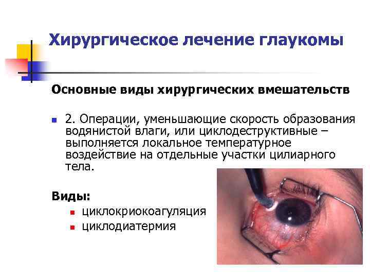 Хирургическое лечение глаукомы Основные виды хирургических вмешательств n 2. Операции, уменьшающие скорость образования водянистой