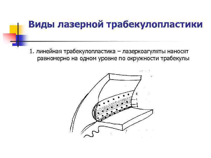 Виды лазерной трабекулопластики 1. линейная трабекулопластика – лазеркоагуляты наносят равномерно на одном уровне по