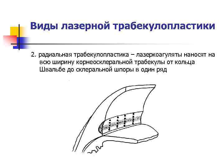 Виды лазерной трабекулопластики 2. радиальная трабекулопластика – лазеркоагуляты наносят на всю ширину корнеосклеральной трабекулы