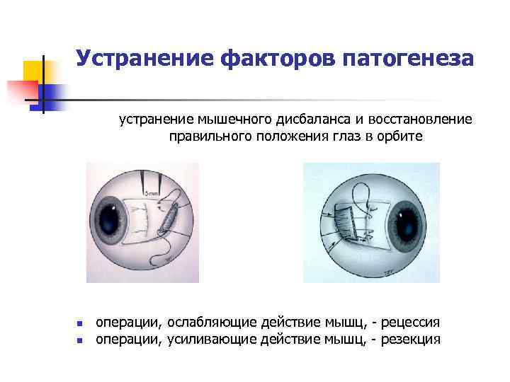 Устранение факторов патогенеза устранение мышечного дисбаланса и восстановление правильного положения глаз в орбите n
