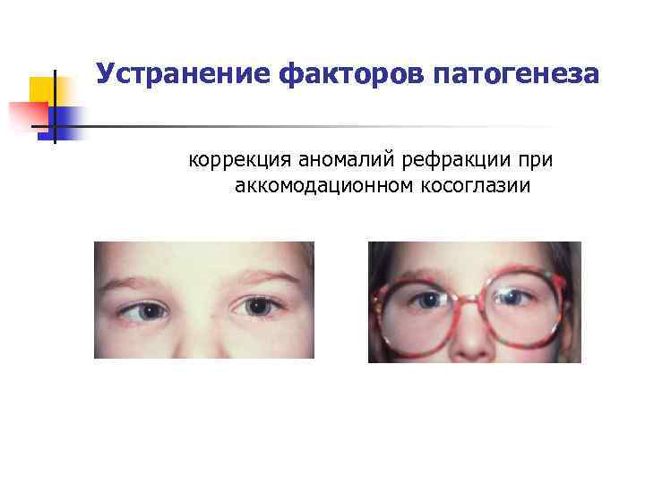 Устранение факторов патогенеза коррекция аномалий рефракции при аккомодационном косоглазии 