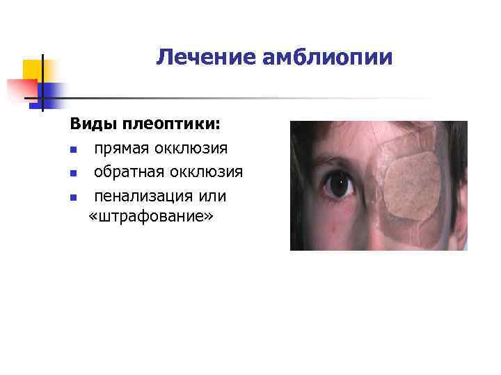 Лечение амблиопии Виды плеоптики: n прямая окклюзия n обратная окклюзия n пенализация или «штрафование»
