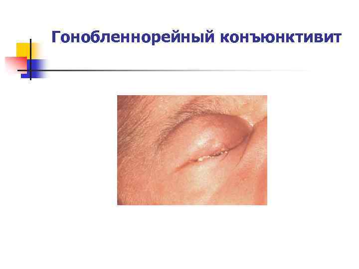 Гонобленнорейный конъюнктивит 