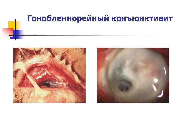 Гонобленнорейный конъюнктивит 