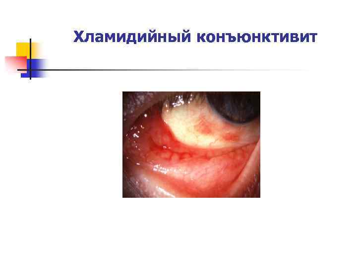 Хламидийный конъюнктивит 
