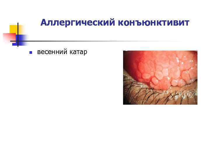 Весенний катар фото офтальмология