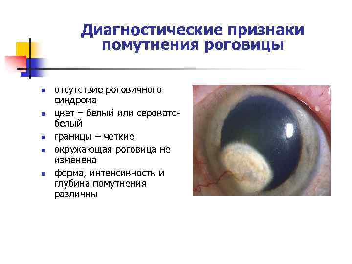 Диагностические признаки помутнения роговицы n n n отсутствие роговичного синдрома цвет – белый или