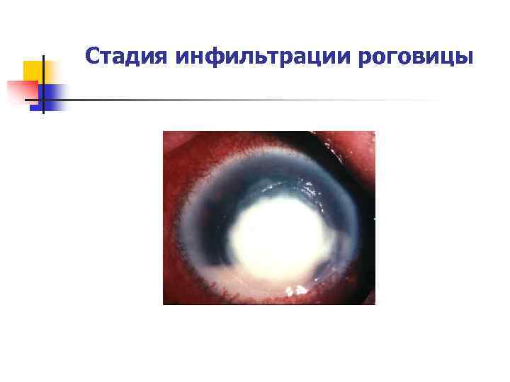 Стадия инфильтрации роговицы 
