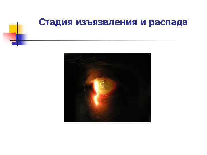 Стадия изъязвления и распада 