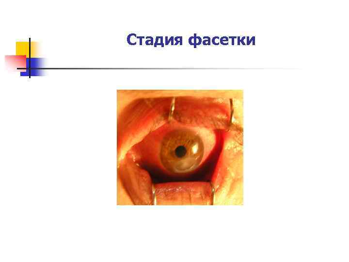 Стадия фасетки 