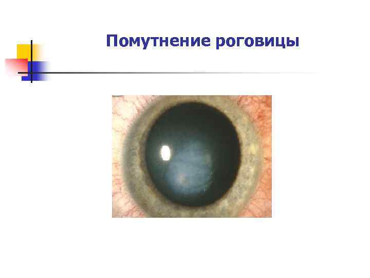 Помутнение роговицы 