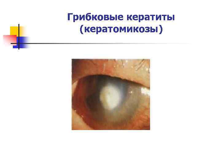 Грибковые кератиты (кератомикозы) 