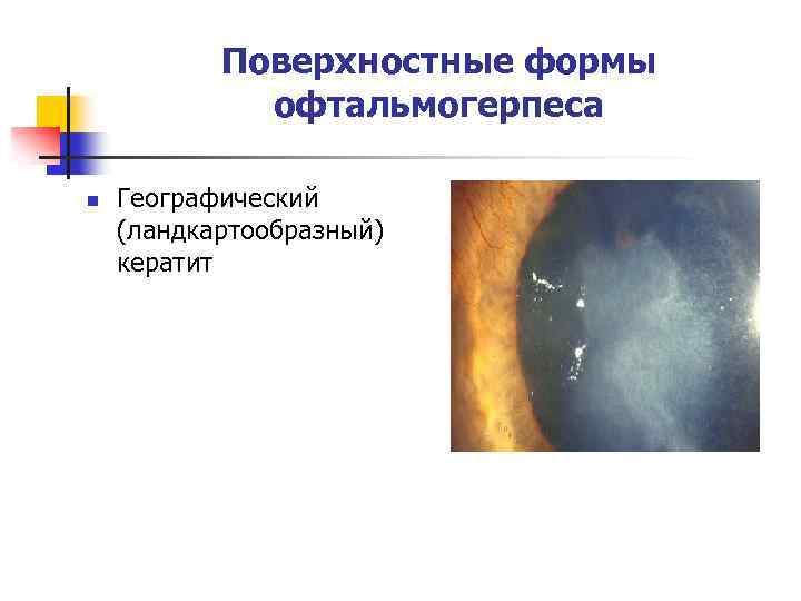 Поверхностные формы офтальмогерпеса n Географический (ландкартообразный) кератит 