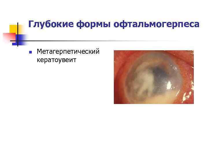 Глубокие формы офтальмогерпеса n Метагерпетический кератоувеит 