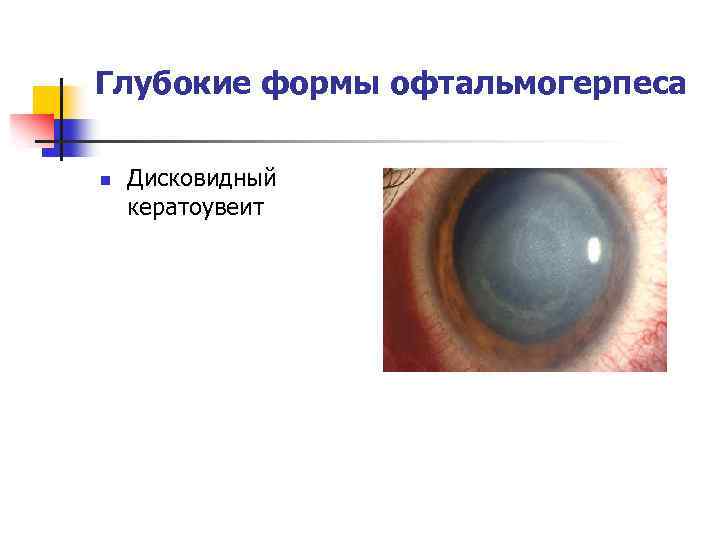 Глубокие формы офтальмогерпеса n Дисковидный кератоувеит 