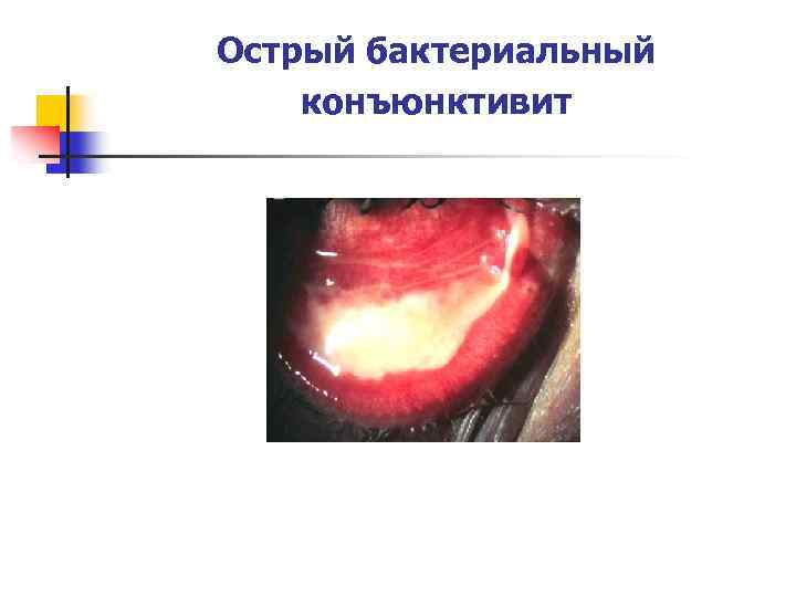 Острый бактериальный конъюнктивит 