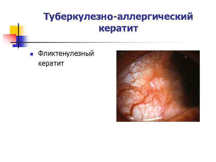 Туберкулезно-аллергический кератит n Фликтенулезный кератит 