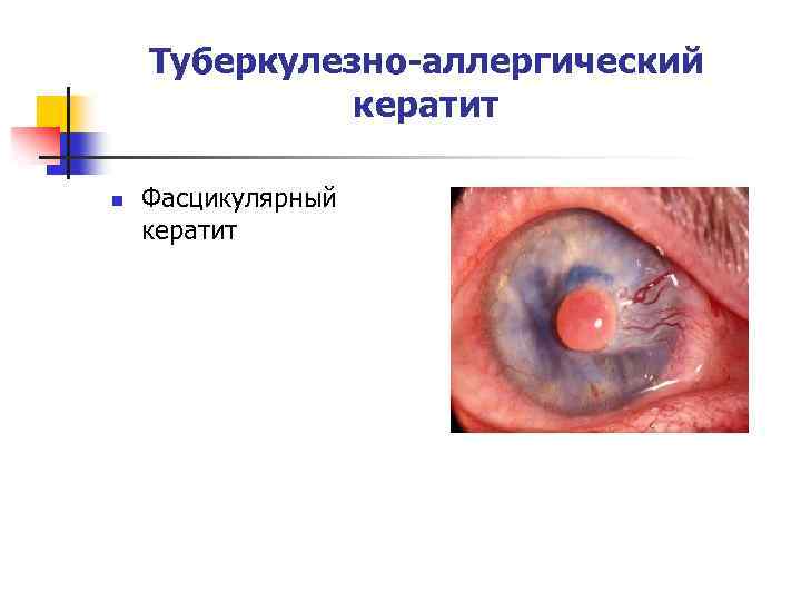 Туберкулезно-аллергический кератит n Фасцикулярный кератит 