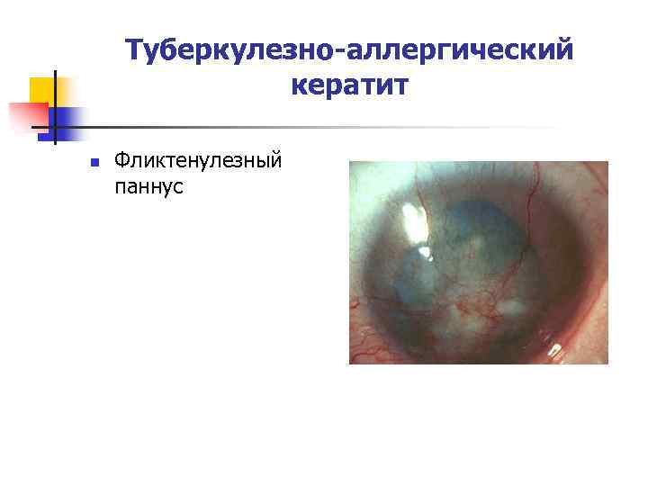 Туберкулезно-аллергический кератит n Фликтенулезный паннус 