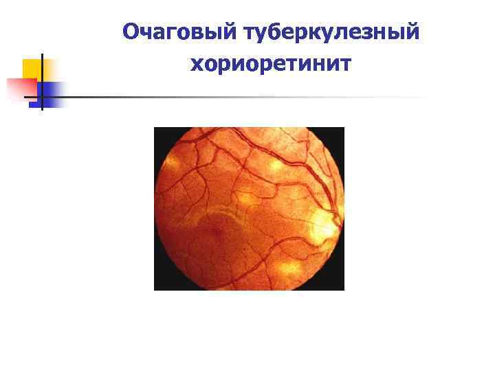 Очаговый туберкулезный хориоретинит 
