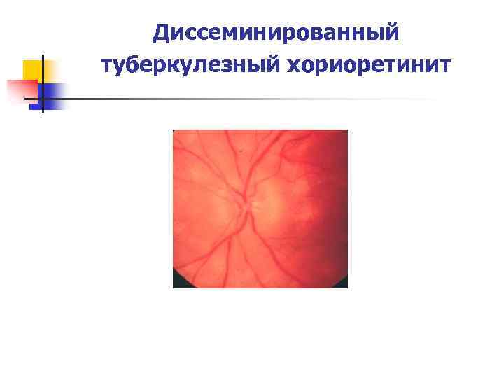 Диссеминированный туберкулезный хориоретинит 