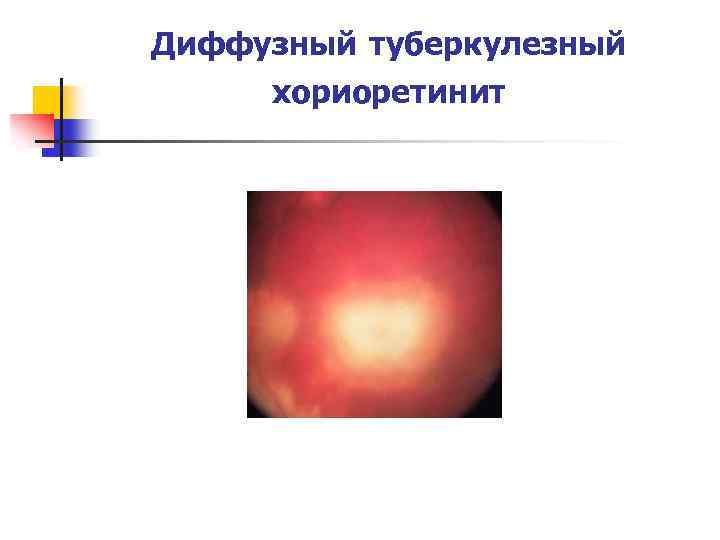 Диффузный туберкулезный хориоретинит 