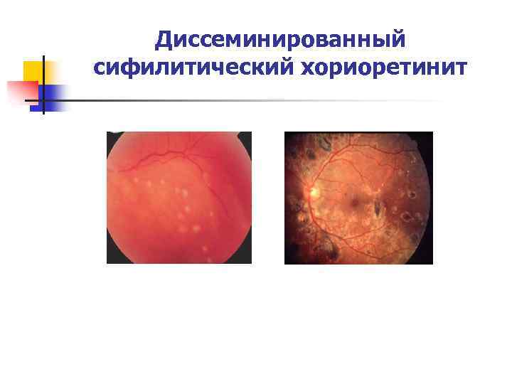 Диссеминированный сифилитический хориоретинит 