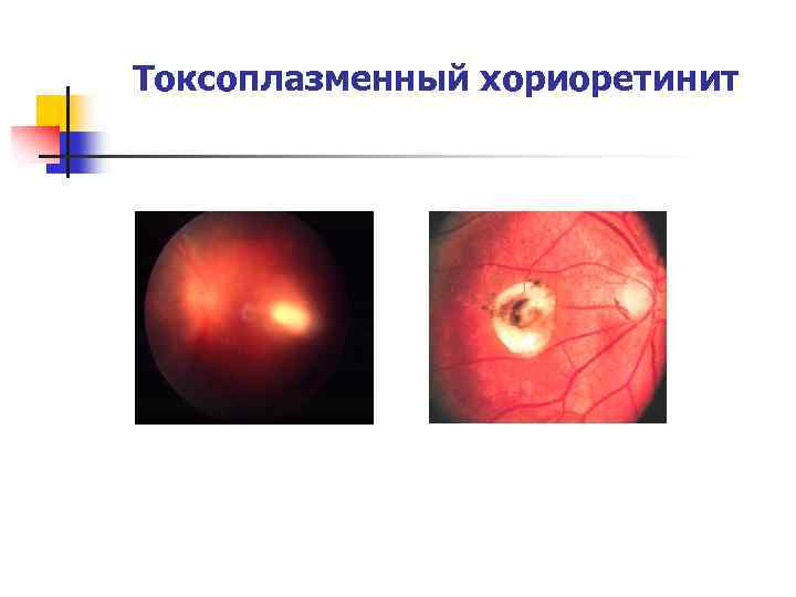 Токсоплазменный хориоретинит 
