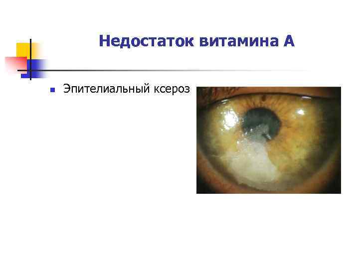 Недостаток витамина А n Эпителиальный ксероз 