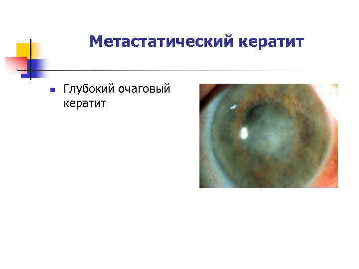 Метастатический кератит n Глубокий очаговый кератит 
