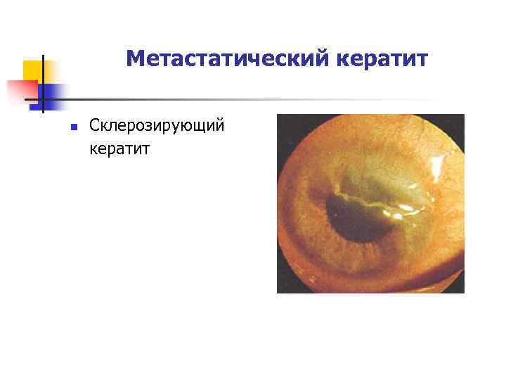 Метастатический кератит n Склерозирующий кератит 