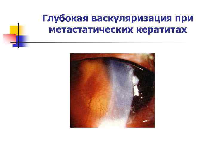 Глубокая васкуляризация при метастатических кератитах 