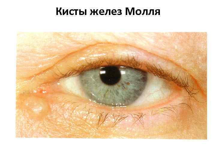 Кисты желез Молля 