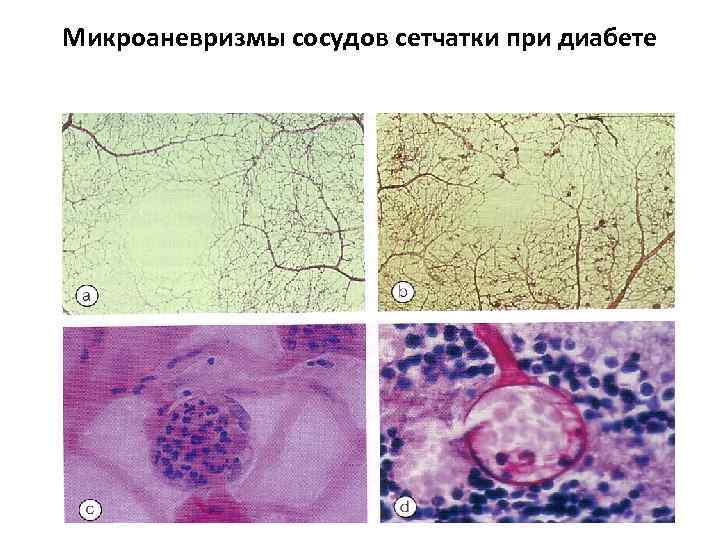 Микроаневризмы сосудов сетчатки при диабете 