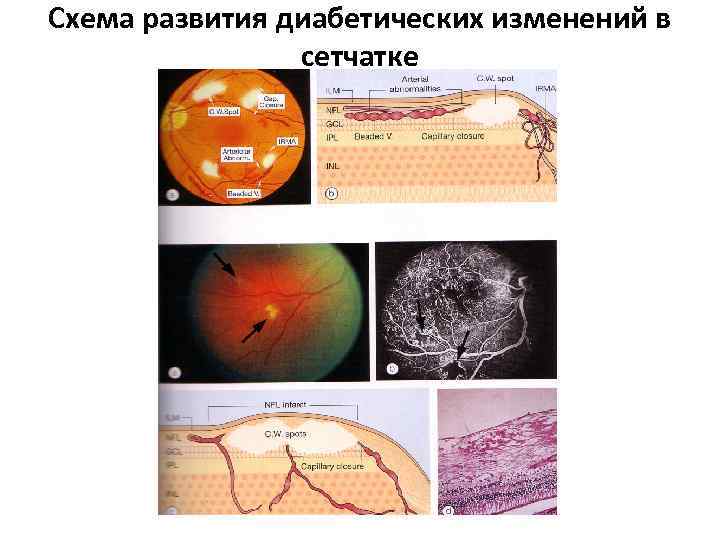 Схема развития диабетических изменений в сетчатке 