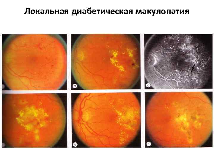 Локальная диабетическая макулопатия 