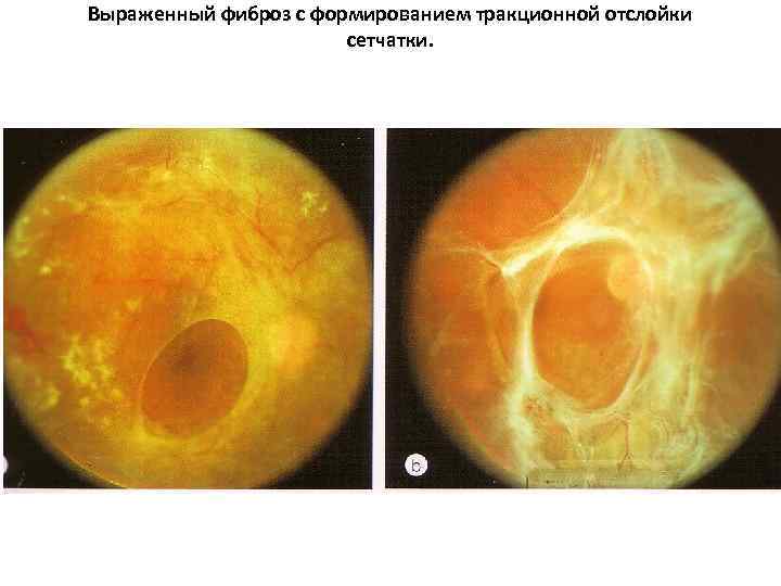 Фиброз сетчатки глаза причины и лечение